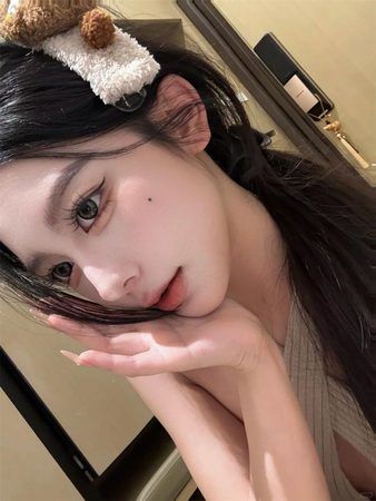 双眼皮修复即刻效果